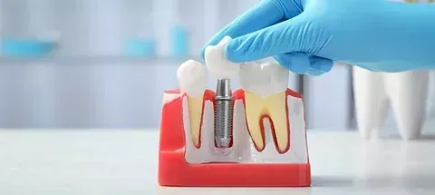 wilmington-dental-implants-specialist-big-0