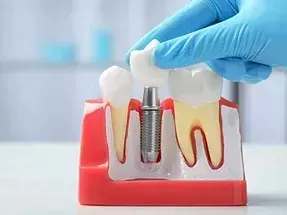 wilmington-dental-implants-specialist