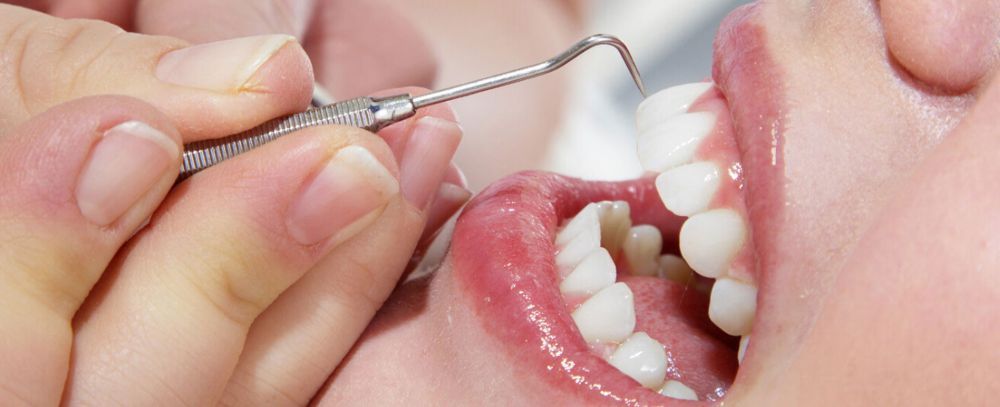 expert-teeth-cleaning-downtown-seattle-for-healthy-smiles-big-0