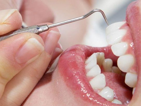 expert-teeth-cleaning-downtown-seattle-for-healthy-smiles