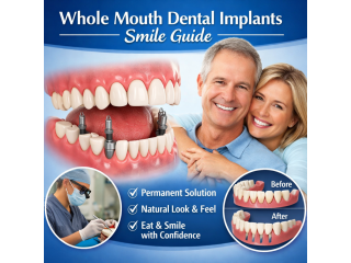 whole-mouth-dental-implants-smile-guide-small-0