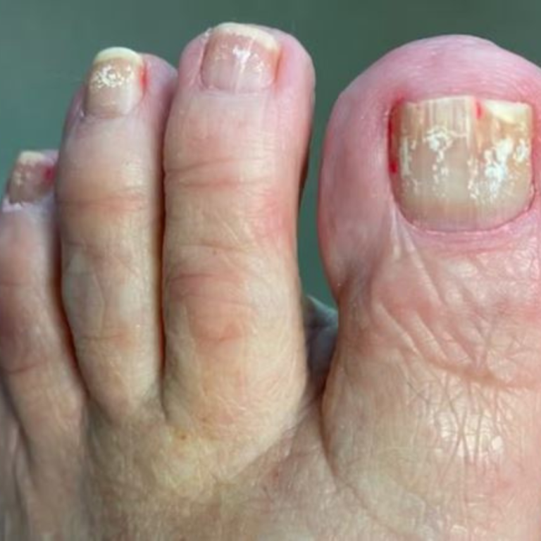 white-marks-on-toenails-causes-and-treatment-guide-big-0