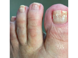 white-marks-on-toenails-causes-and-treatment-guide-small-0