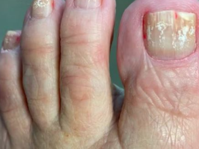 white-marks-on-toenails-causes-and-treatment-guide