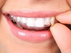 get-the-smile-you-deserve-with-adult-braces-near-you