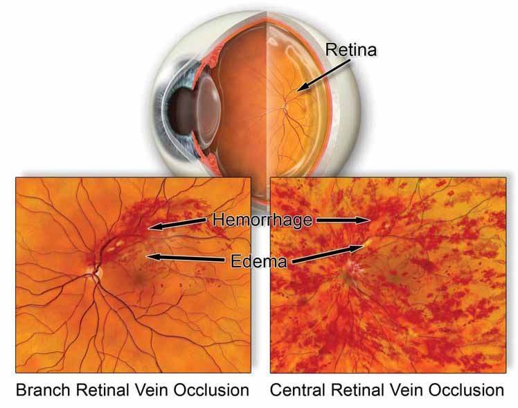 expert-care-for-retinal-circulatory-problems-management-big-0