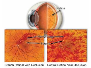 expert-care-for-retinal-circulatory-problems-management-small-0