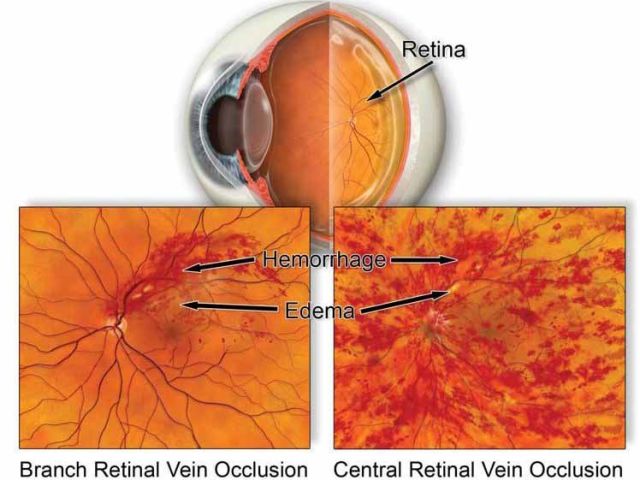 expert-care-for-retinal-circulatory-problems-management