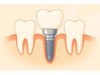 best-dentures-implants-treatment-center-in-portlandor-small-1