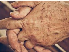 singapore-freckle-treatment-by-lim-clinic-and-surgery