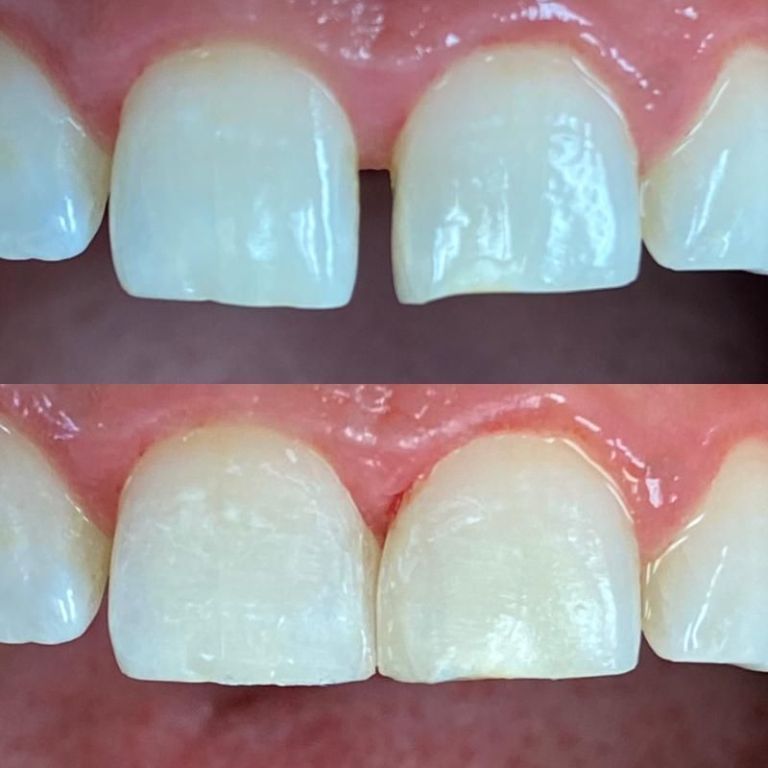 transform-your-smile-instantly-with-lumineers-big-0