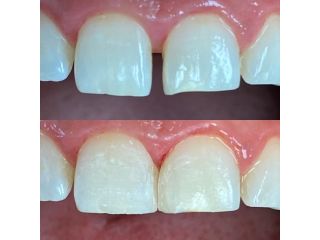 transform-your-smile-instantly-with-lumineers-small-0
