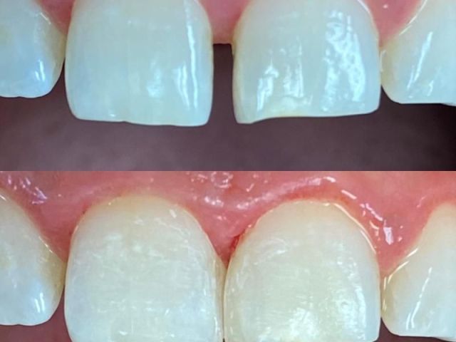 transform-your-smile-instantly-with-lumineers