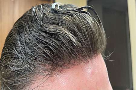 non-surgical-hair-restoration-in-california-big-0