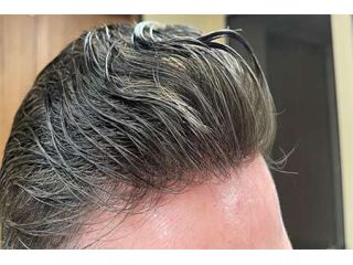 non-surgical-hair-restoration-in-california-small-0