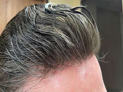 non-surgical-hair-restoration-in-california