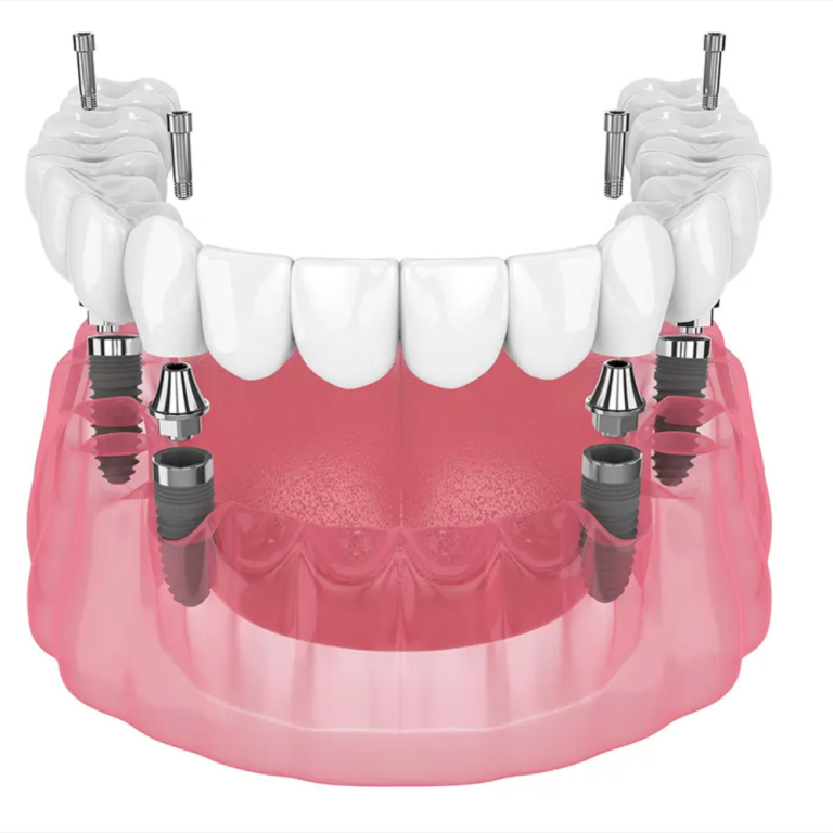 revolutionize-your-smile-lower-denture-implants-are-taking-over-big-0