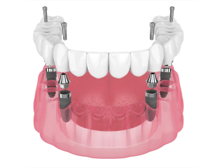 revolutionize-your-smile-lower-denture-implants-are-taking-over-small-0