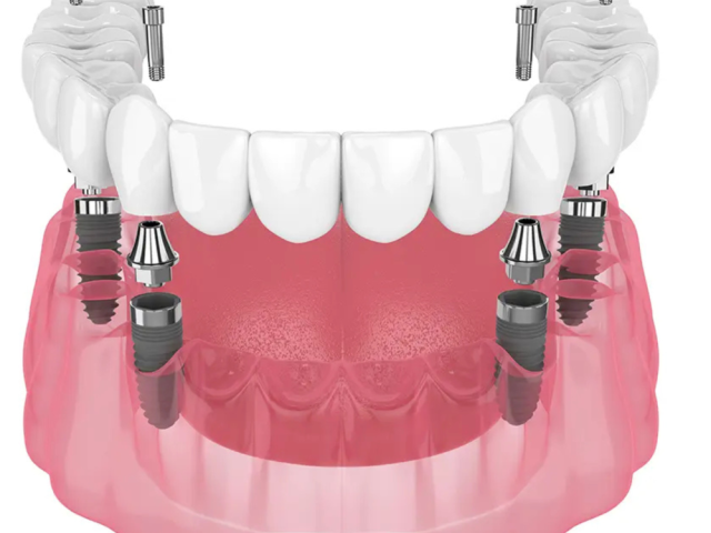 revolutionize-your-smile-lower-denture-implants-are-taking-over