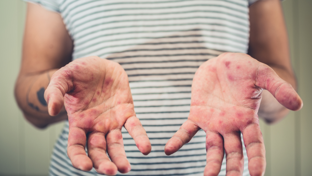 measles-cases-are-rising-again-are-you-protected-big-0