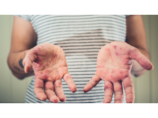 measles-cases-are-rising-again-are-you-protected-small-0