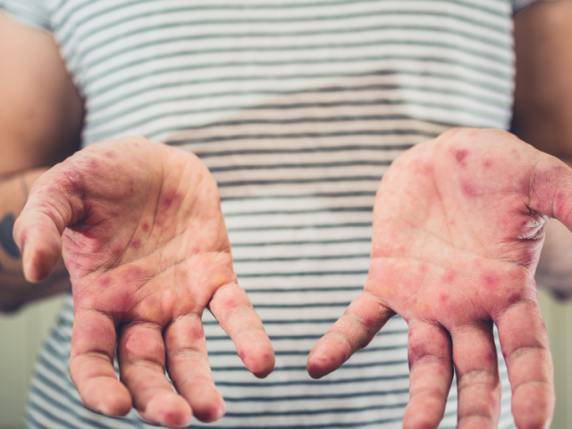 measles-cases-are-rising-again-are-you-protected