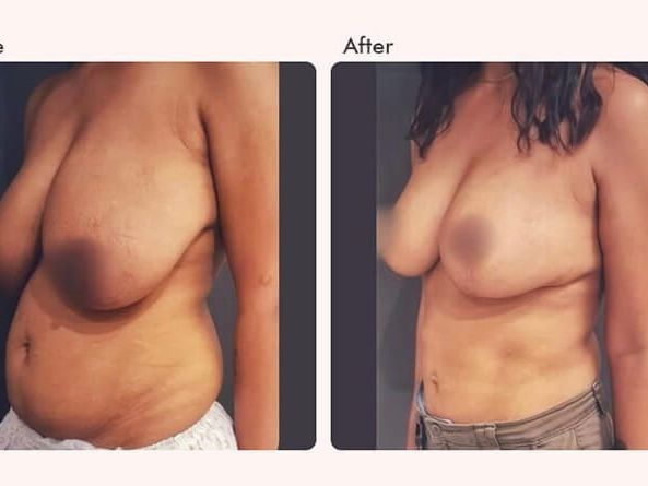 what-is-the-best-clinic-for-a-tummy-tuck-in-houston-tx