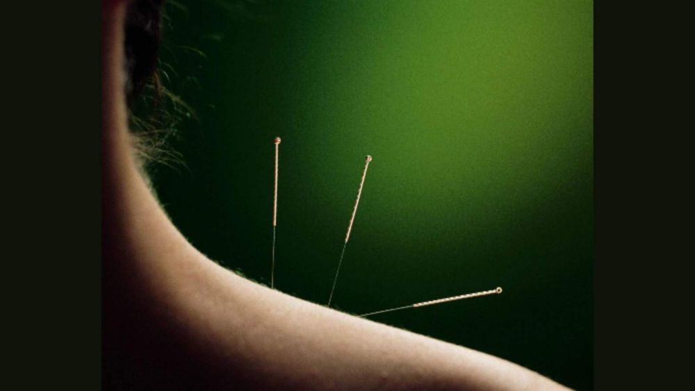 top-rated-dry-needle-therapy-san-francisco-big-0