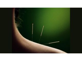 top-rated-dry-needle-therapy-san-francisco-small-0