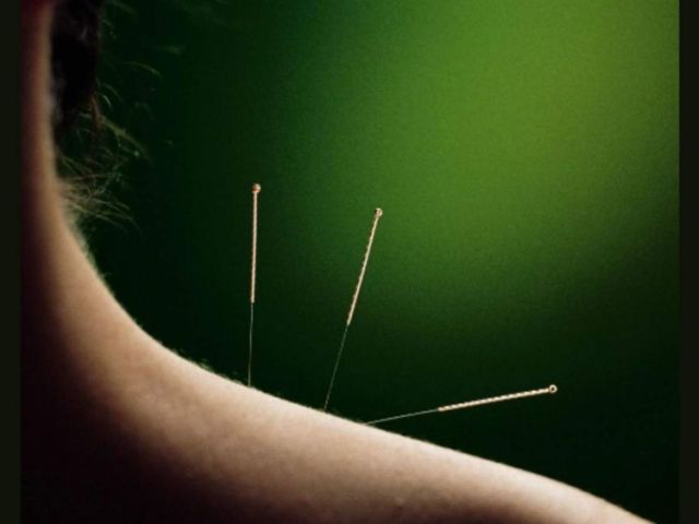 top-rated-dry-needle-therapy-san-francisco