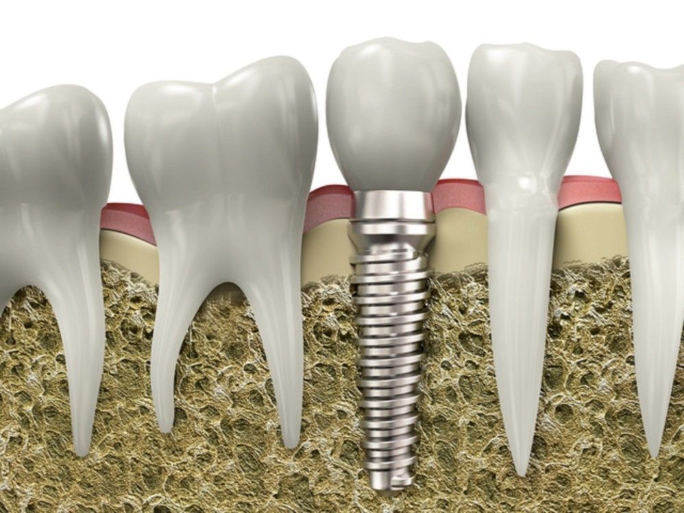 are-denture-implants-worth-it-big-1