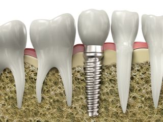 are-denture-implants-worth-it-small-1