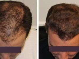 hair-restoration-for-men-in-pompano-beach-fl-regrow-hair-fast