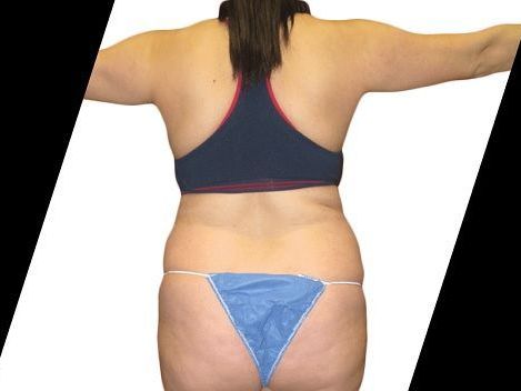 what-areas-of-the-thighs-can-be-improved-with-a-thigh-lift