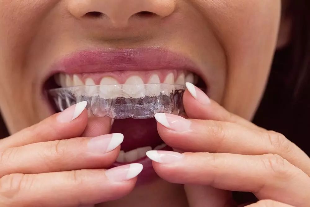 what-are-6-month-braces-and-how-do-they-work-big-0