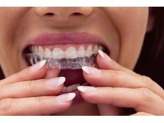 what-are-6-month-braces-and-how-do-they-work-small-0