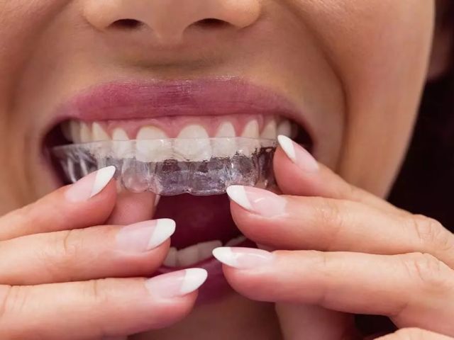 what-are-6-month-braces-and-how-do-they-work