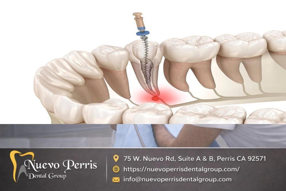 top-rated-root-canal-treatment-in-menifee-gentle-dentistry-big-0