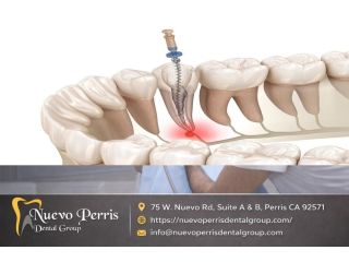 top-rated-root-canal-treatment-in-menifee-gentle-dentistry-small-0