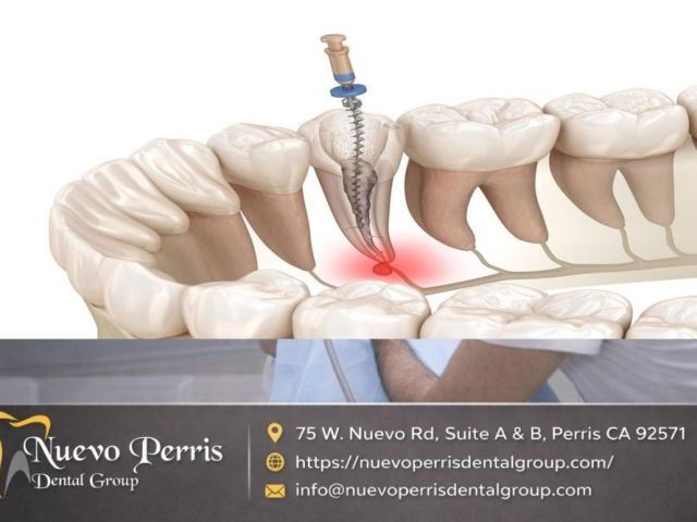 top-rated-root-canal-treatment-in-menifee-gentle-dentistry