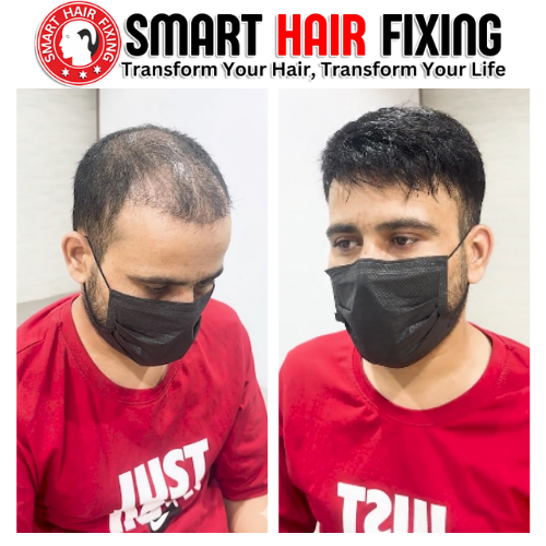 welcome-to-smart-hair-fixing-hair-replacement-experts-in-uae-big-1