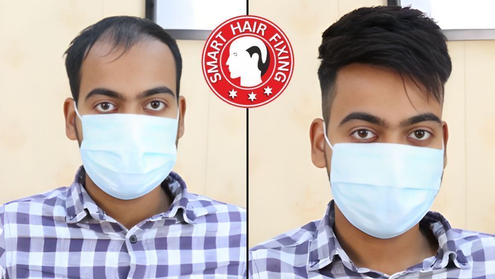smart-hair-fixing-in-oman-natural-look-instant-results-big-2