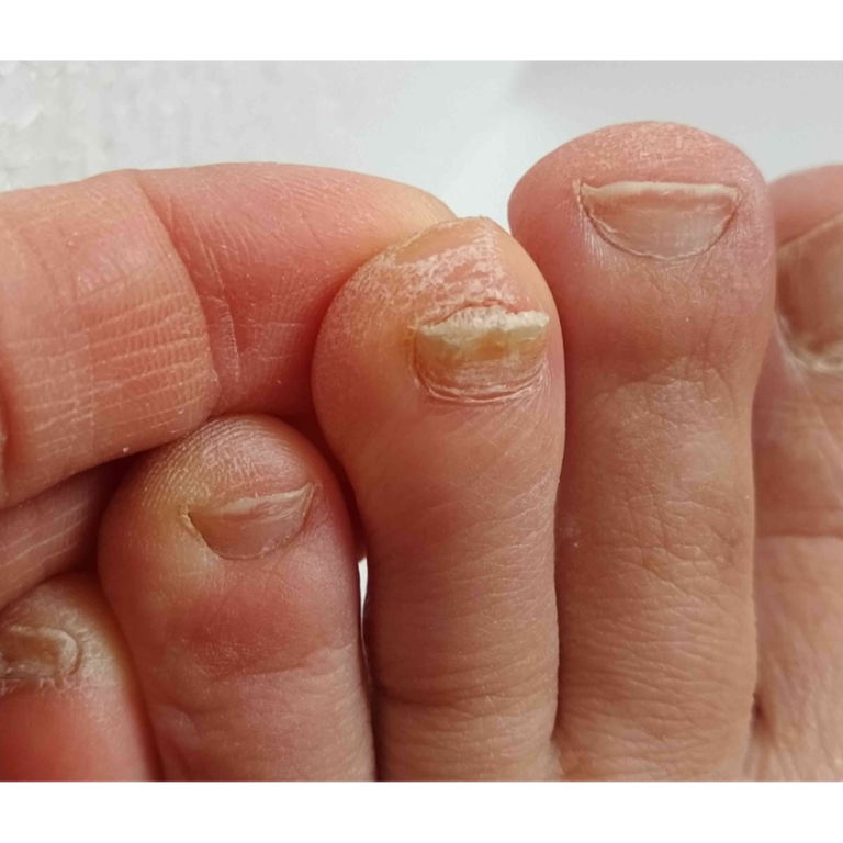 get-white-marks-on-toenails-causes-and-treatment-guide-big-0