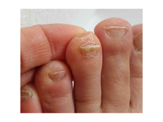 get-white-marks-on-toenails-causes-and-treatment-guide-small-0