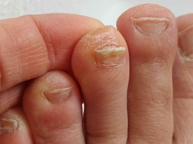 get-white-marks-on-toenails-causes-and-treatment-guide