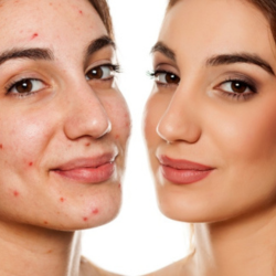 acne-treatments-fort-collins-clear-healthy-skin-solutions-big-0
