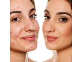 acne-treatments-fort-collins-clear-healthy-skin-solutions-small-0