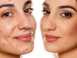 acne-treatments-fort-collins-clear-healthy-skin-solutions