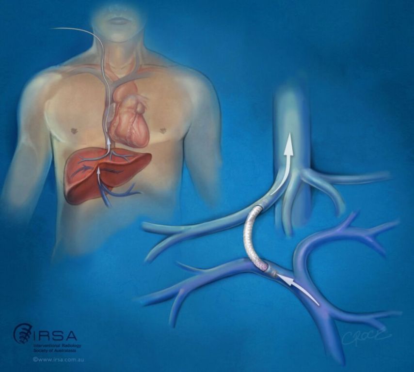 advanced-transjugular-intrahepatic-portosystemic-shunt-treatment-big-0