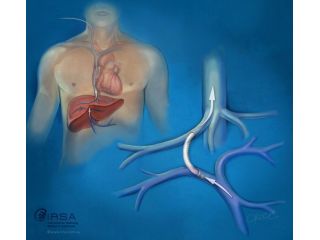 advanced-transjugular-intrahepatic-portosystemic-shunt-treatment-small-0